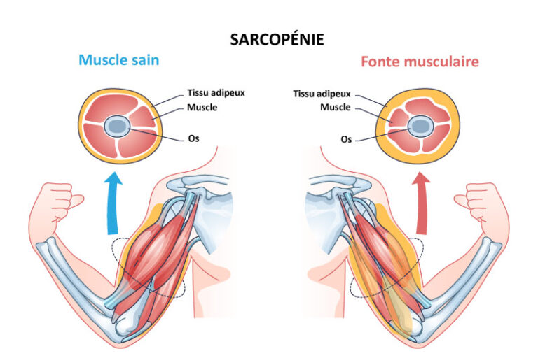 Tout sur la sarcopénie définition diagnostic et traitement