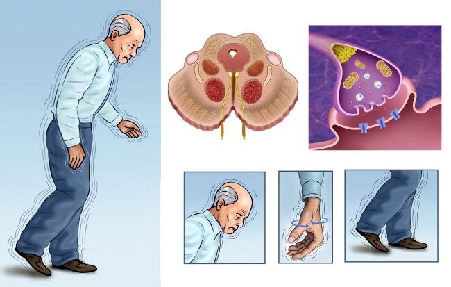 Parkinson’s: 7 myths and realities