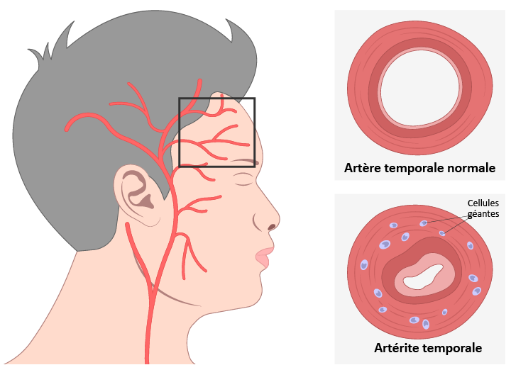 illustration de l'artère temporale et son inflammation dans la maladie de Horton ou artérite temporale