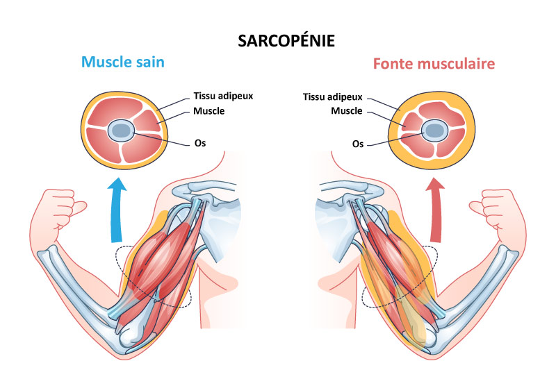 Schéma de la fonte musculaire entraînant la sarcopénie