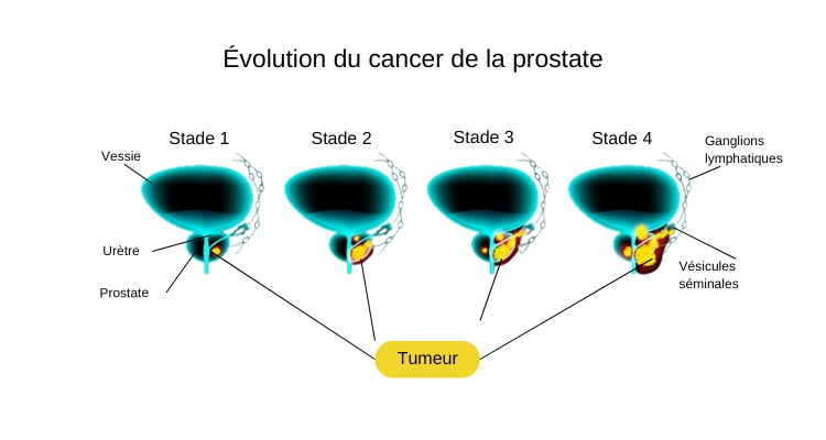 Évolution de la tumeur dans la prostate