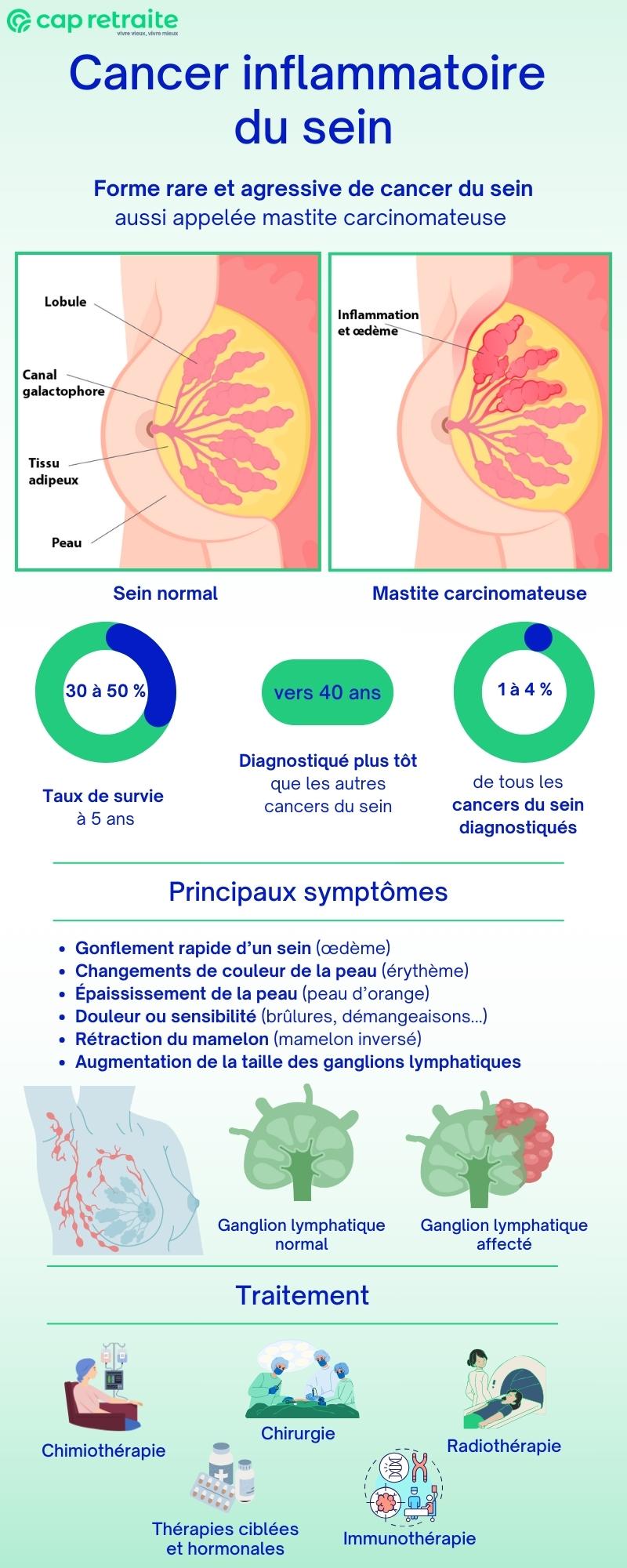 Infographie sur le cancer inflammatoire du sein : définition, symptômes et traitement