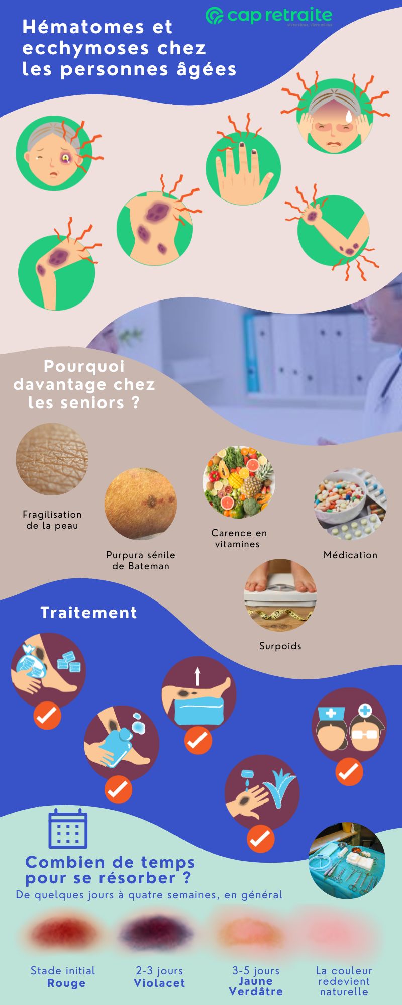 Infographie sur les hématomes et ecchymoses chez les personnes âgées