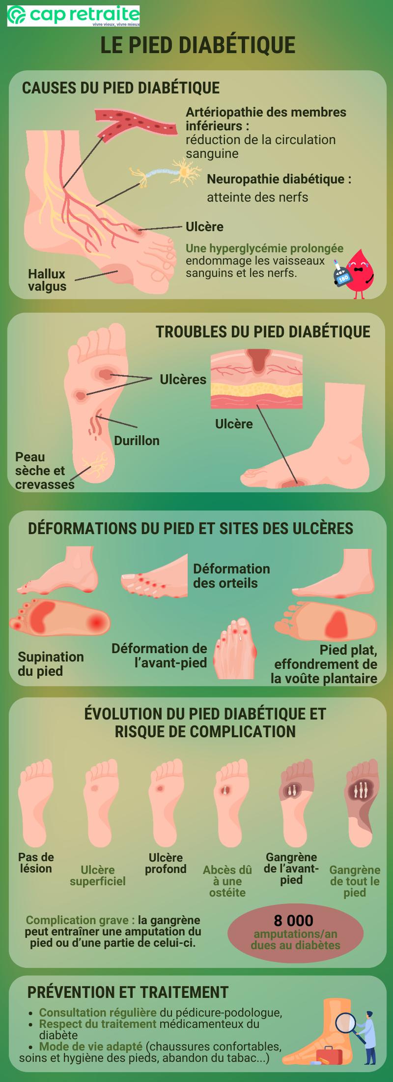 Infographie sur le pied diabétique, ses signes et la prévention