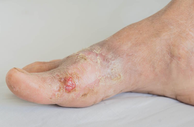 Pied diabétique : photos des pieds d'une personne âgée atteinte d'eczéma lié au diabète