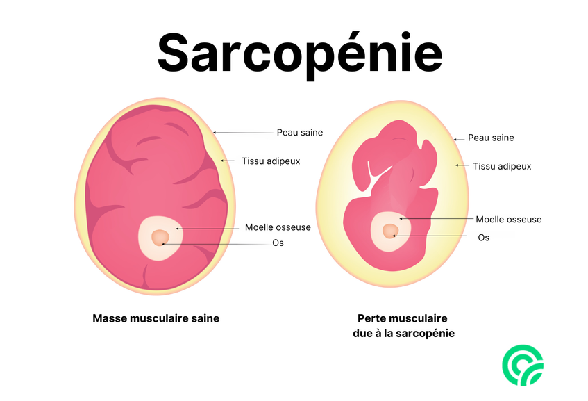 Schéma de la sarcopénie ou perte musculaire pouvant resulter d'une créatinine basse